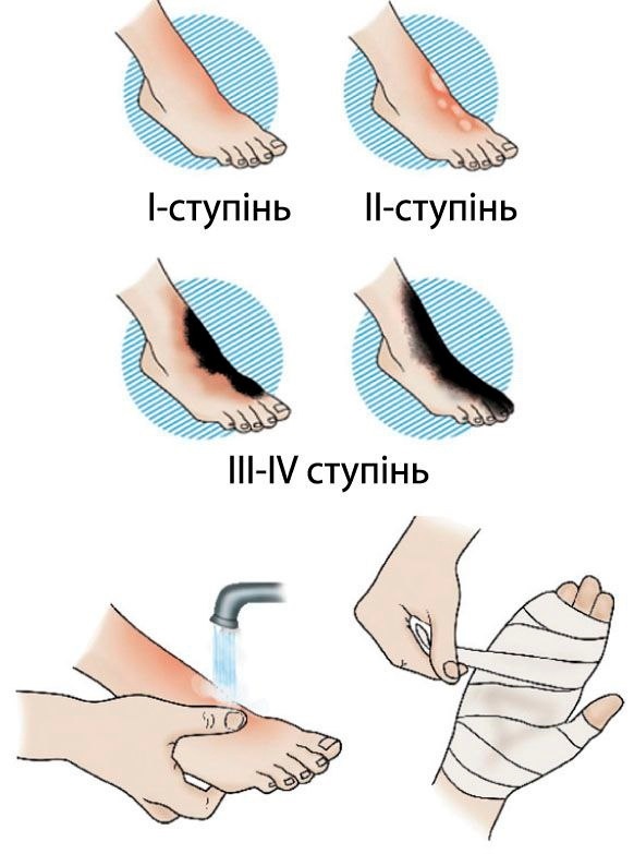 перша медична допомога при опіках